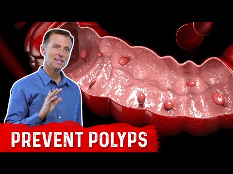 What is a Polyp? – The Best Food for Colon Polyp Prevention – Dr. Berg
