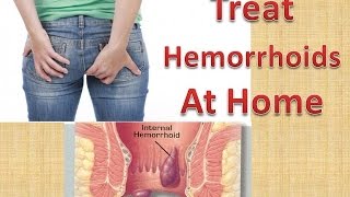 How To Treat HEMORRHOIDS At Home Quickly & Naturally Without Surgery