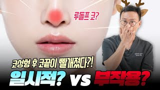 코성형 후 빨개진 코끝! 지금 당장 병원 가? 말아?
