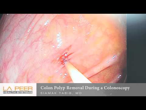 Colorectal Videos