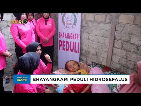 KETUA BHAYANGKARI POLDA MALUT KUNJUNGI ANAK PENDERITA HIDROSEFALUS