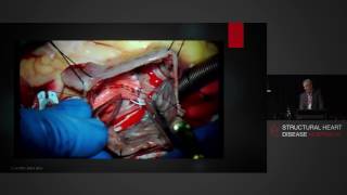 Surgical Repair of Atrial Septal Defects – Mr Simon Moten