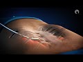 Modified Nuss Procedure for Pectus Excav