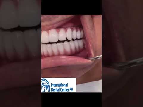 Full Mouth Restoration on a Budget: Dental Implants Guide for Puerto Vallarta, Mexico
