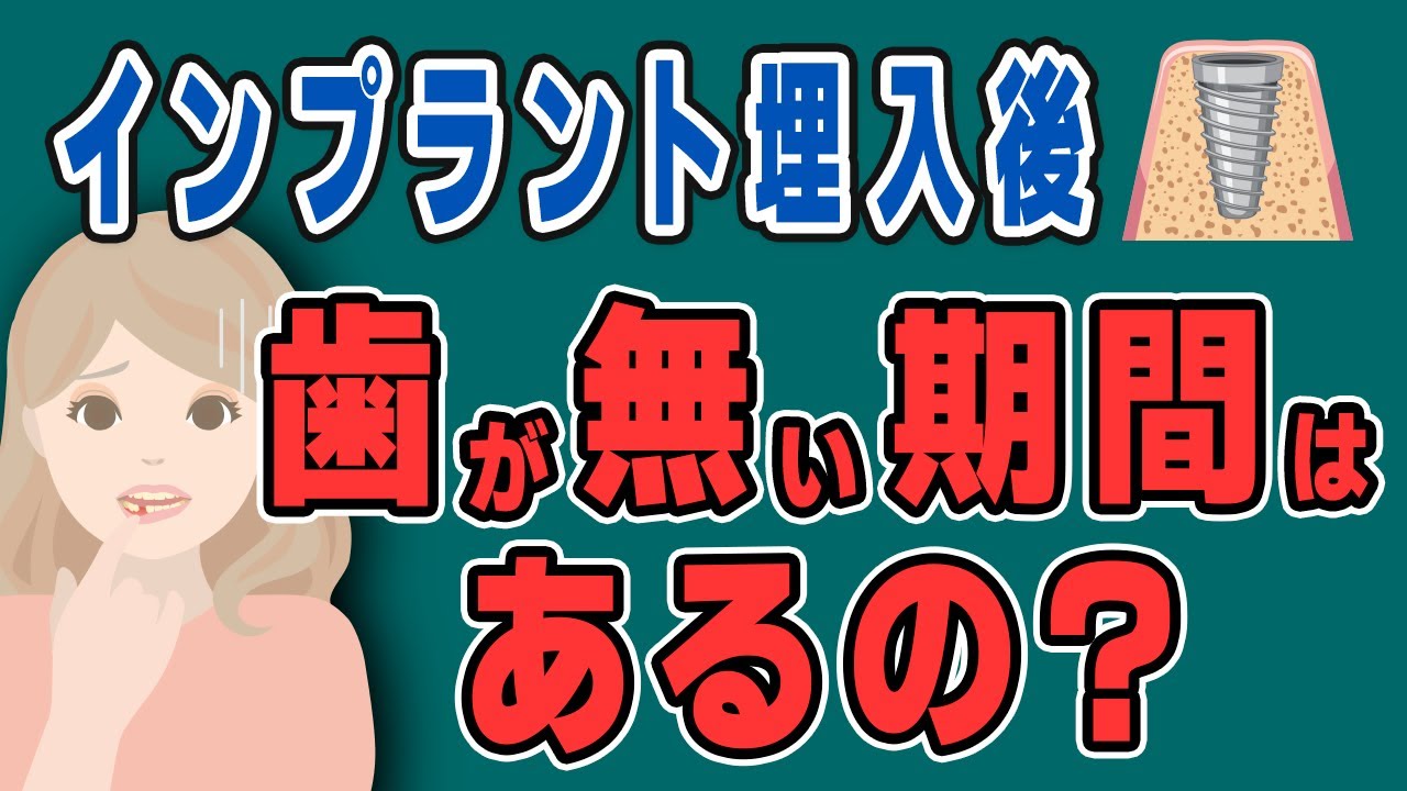 インプラント治療で歯がない期間はどのくらいある?【仮歯】