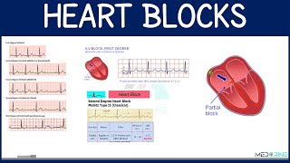 Atrioventricular (AV) Heart Blocks | 1st, 2nd & 3rd Degree AV Blocks Made Easy