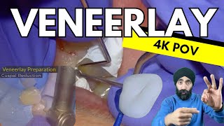 Premolar Veneerlay Prep FULL Clinical Walkthrough 4K POV - Challenging Scenario!