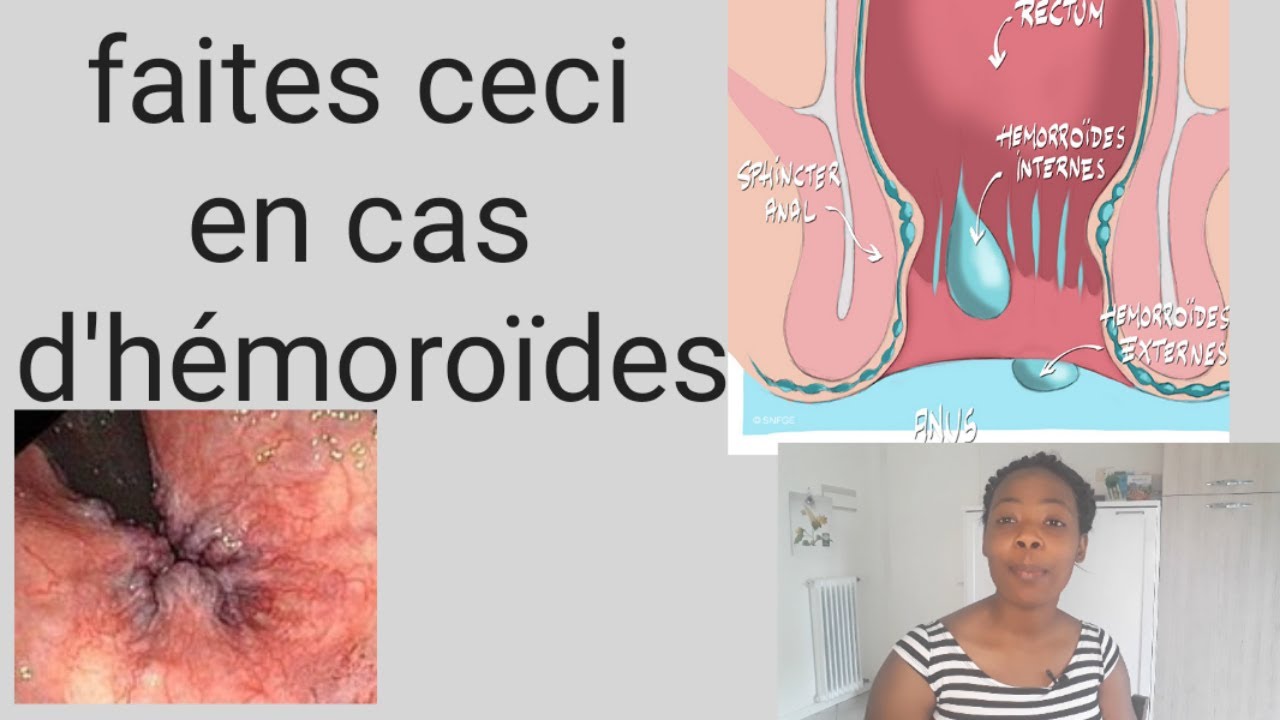 Hémoroïdes: traitement