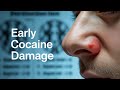 Early Signs Your Nose Needs A Break From Cocaine