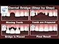 Dental Bridge Procedure Step By Step