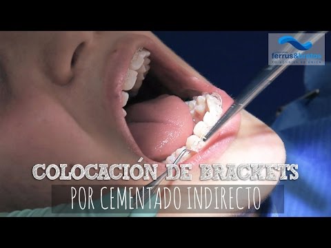 Colocación de brackets de Zafiro