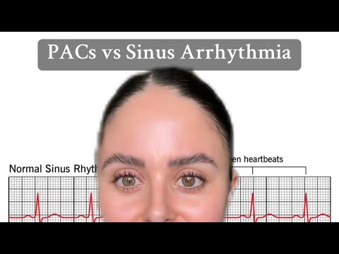 PACs vs Sinus Arrhythmia