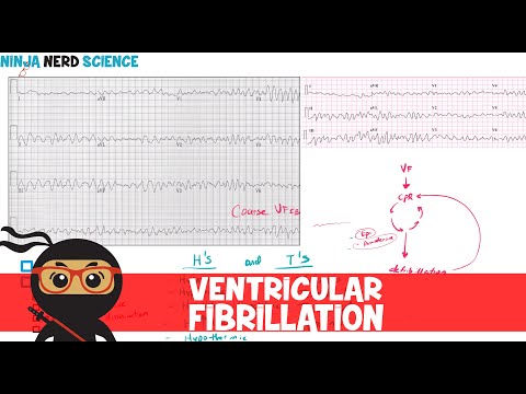 Rate and Rhythm Normal Sinus Rhythm