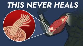 Why your tendons never heal