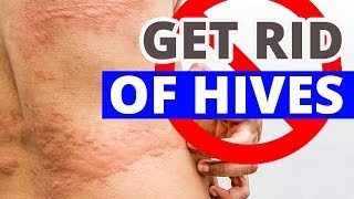 How to Get Rid of Hives Permanently | How Can you REALLY Cure Hives?