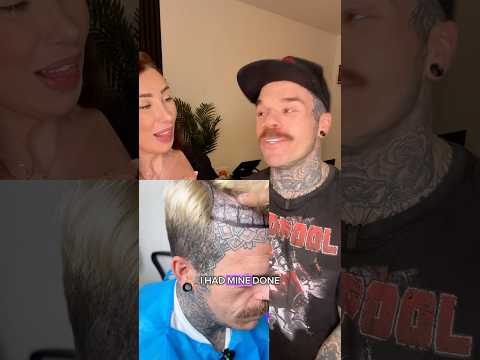 3 month Hair transplant update 🫶🏻 #hairtransplant #hair #fyp #couple