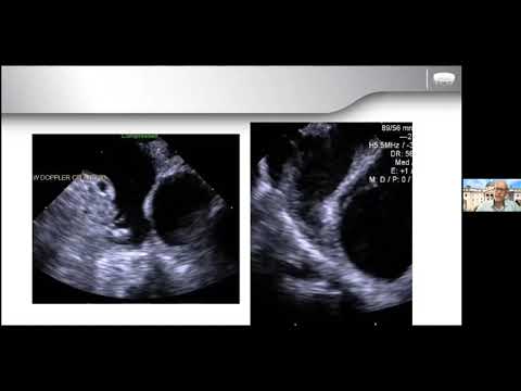 Stroke Prevention in AF. Left atrial appendage closure devices.