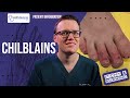 How To Get Rid Of CHILBLAINS (Pernio): Itchy Sores On Your Fingers And Toes - Doctor Explains