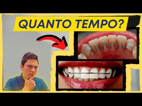 POR QUANTO TEMPO SE DEVE USAR A CONTENÇÃO ORTODÔNTICA?