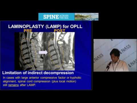 2015 Spine Across the Sea Paper Presentation:  Walking in Adult Spinal Deformity Patients