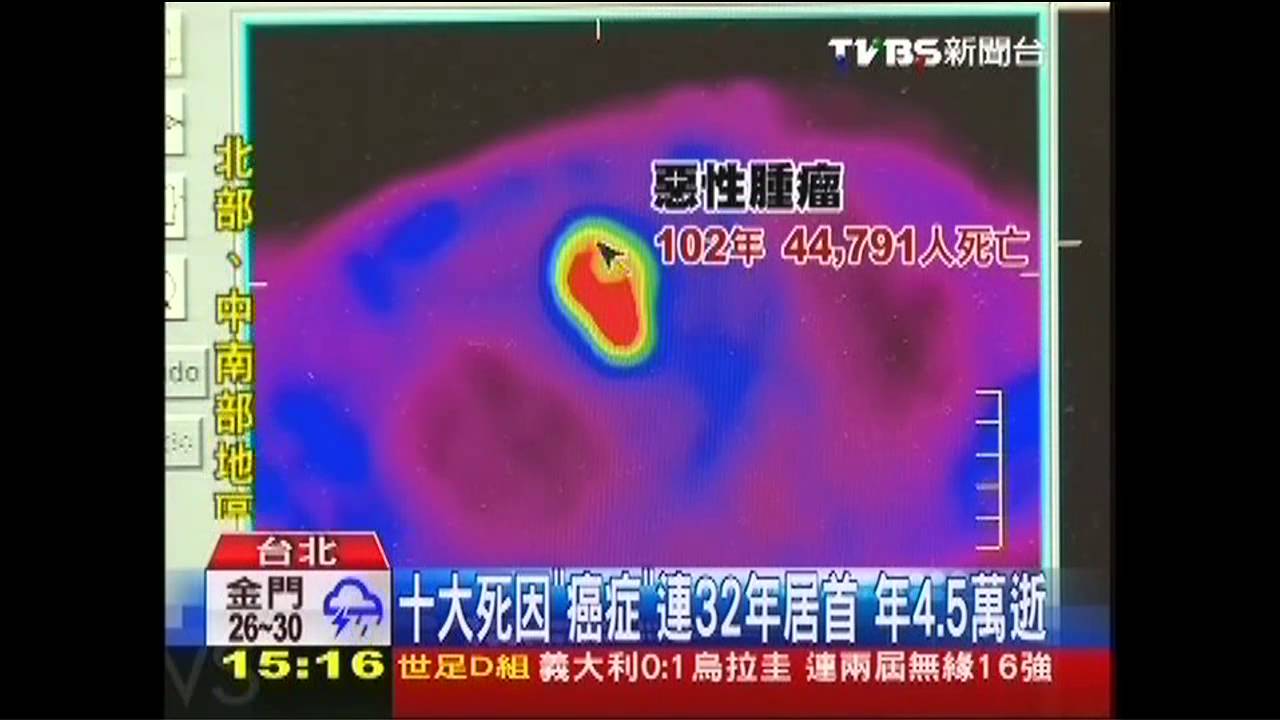 十大死因「癌症」連32年居首　年4.5萬逝