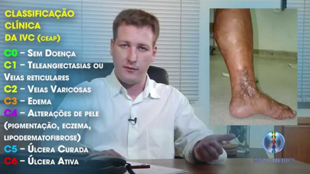 Insuficiência venosa cronica 1/4
