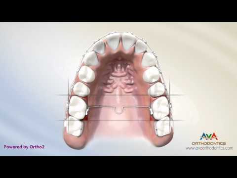 Orthodontic Space Management - TPA Appliance