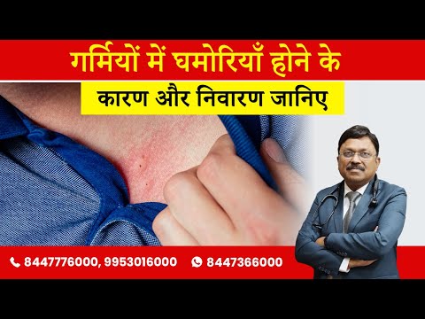 गर्मियों में घमोरियाँ होने के कारण और निवारण जानिए | Dr. Bimal Chhajer | SAAOL