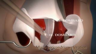 preview picture of video 'Chirurgie du nez Rhinoplastie Docteur Dombard Overijse Bruxelles'