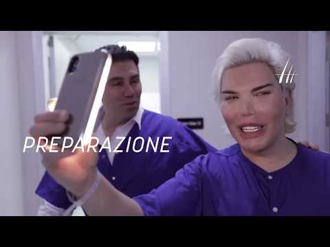 Rodrigo Alves trapianto capelli turchia