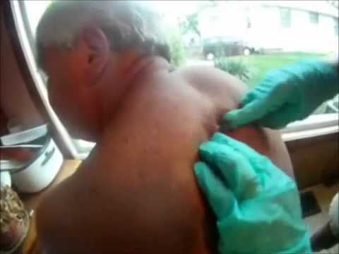 Ile jest powiększenie penisa chirurgia Jaka jest różnica z dużych i małych państw