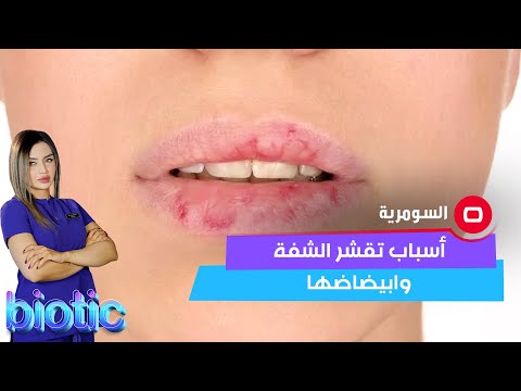 شاهد بالفيديو.. أسباب تقشر الشفة وابيضاضها