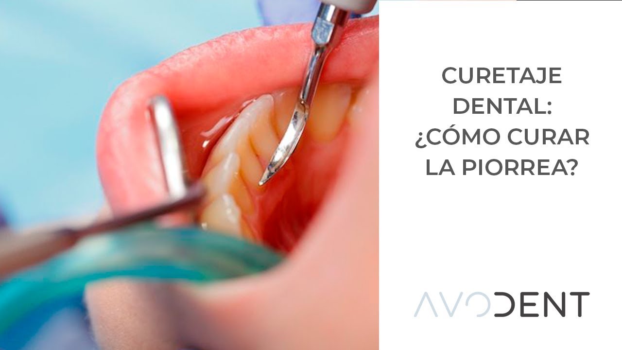 Watch Curetaje dental. ¿cómo se cura la piorrea | Clínica dental en Alcobendas | Avodent Now Curetaje dental. ¿cómo se cura la piorrea | Clínica dental en Alcobendas | Avodent