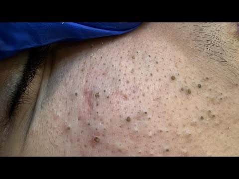 Face Deep Cleansing — Extreme Pore Unclogging Extractions