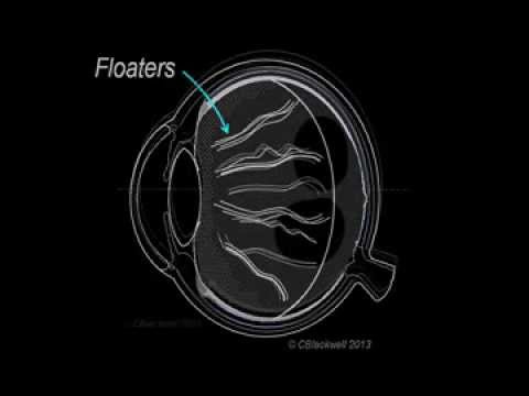 Vitreous Aging And Floaters 1/3