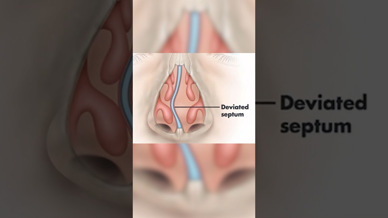 Deviated Septum Explained — Causes, Symptoms & Treatment Options