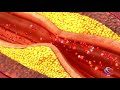 Thumbnail for video with the title: Carotid Endarterectomy Neurosurgery at Carilion Clinic