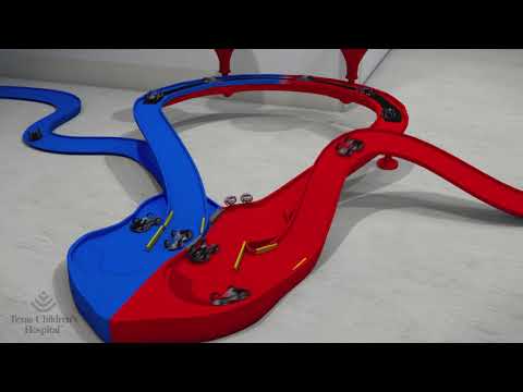 Atrioventricular Septal Defect: Surgical Repair