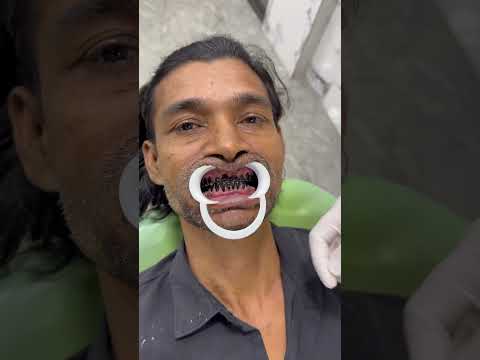 Teeth whitening powder 🦷WhatsApp 03119581698 #song #newsong #dentistteeth #teethwhiteningproducts