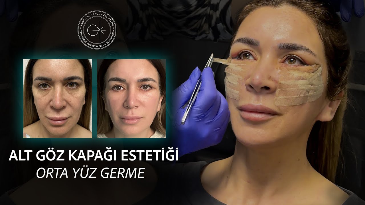 ALT GÖZ KAPAĞI ESTETİĞİ I ORTA YÜZ GERME #gözkapağıestetiği #yüzgerme