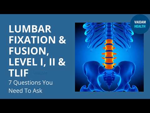 Lumbar Fixation and Fusion - Frequently Asked Questions