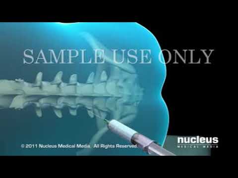 Epidural and combined spinal-epidural anesthesia: Techniques