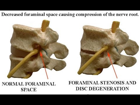 Positive Well Straight Leg Raise Test Large Herniated Disc