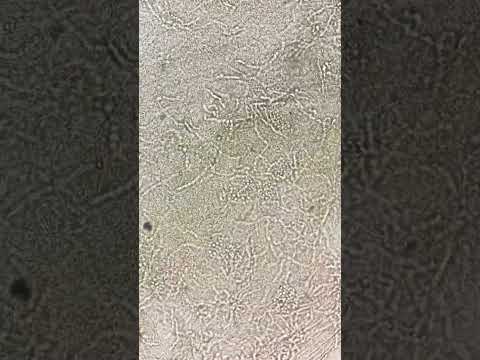 POSITIVE FOR KOH Test (Skin Scraping) | Fungal elements seen #lab #medical #shorts #viral