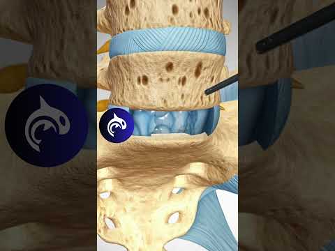 Anterior Lumbar Interbody Fusion ALIF - 4K 3D Animation