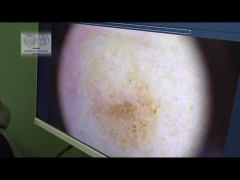 DERMATOLOGIA ALLE SCOTTE, INNOVATIVI STRUMENTI PER LA DIAGNOSI DEL MELANOMA