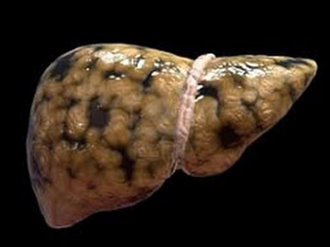Olio di alloro da articolazioni di ulivo Gidromieliya cervicale e toracica midollo spinale