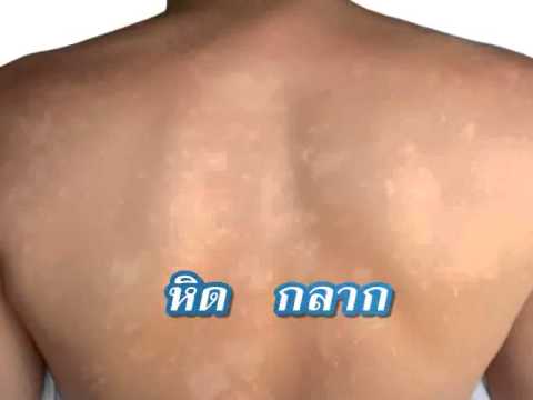 โรคสะเก็ดเงินเป็นโรคที่คล้ายกัน โรคสะเก็ดเงินครีม clotrimazole