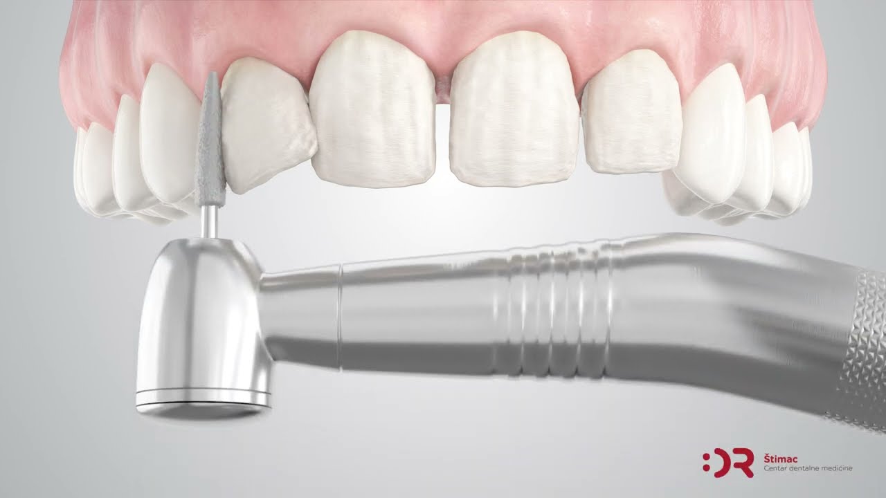 Ljuskice za zube - Veneers | Cijena | Štimac Centar dentalne medicine | Ljuskice za zube | Stomatološka poliklinika Zagreb | Štimac centar dentalne medicine