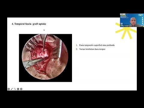 Endoscopic Tympanoplasty on Cadaver